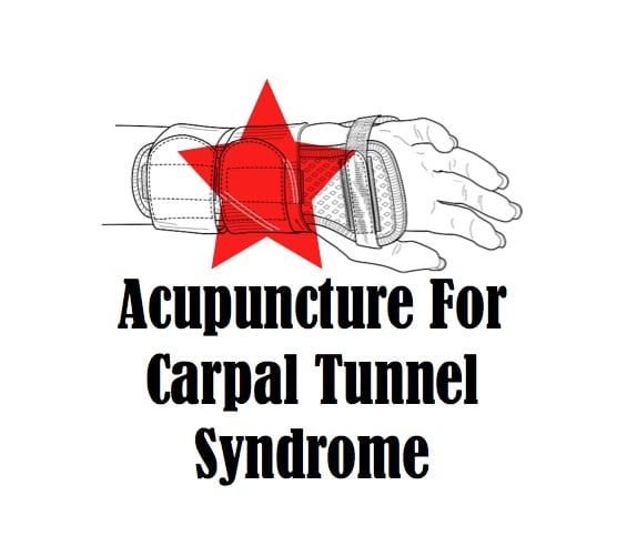 Acupuncture For Carpal Tunnel Syndrome