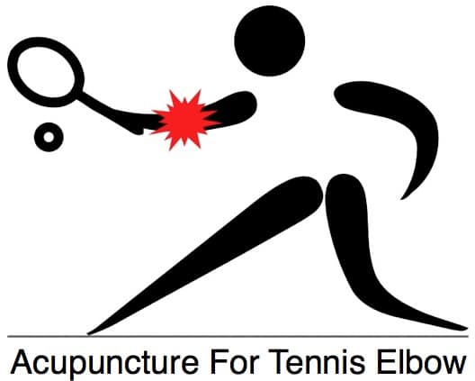 Acupuncture For Tennis Elbow