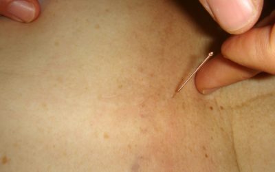 The Benefits of Acupuncture Treatment